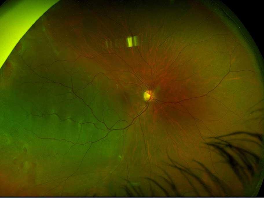 Fundoscopy