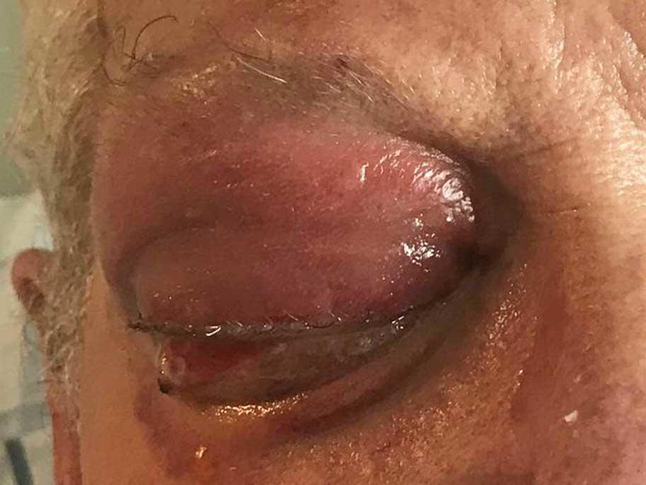 Orbital compartment syndrome
