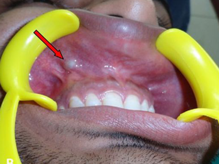 Pellet lodged in maxilla