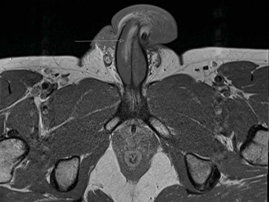 MRI