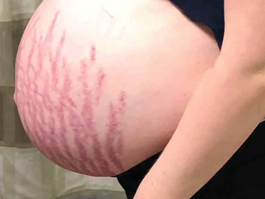 Stretch marks