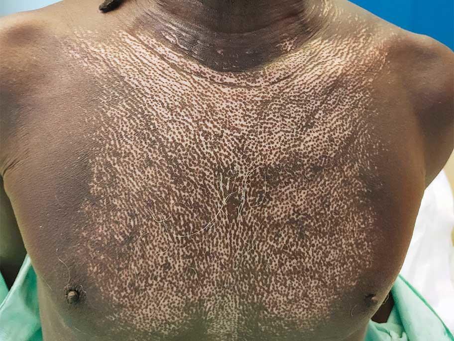 Salt and pepper skin