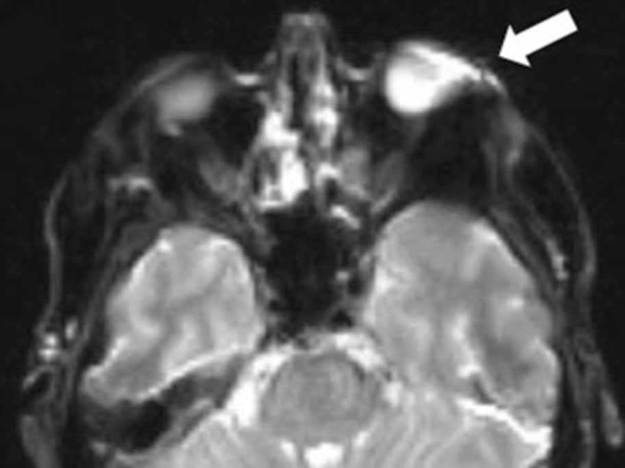 MRI