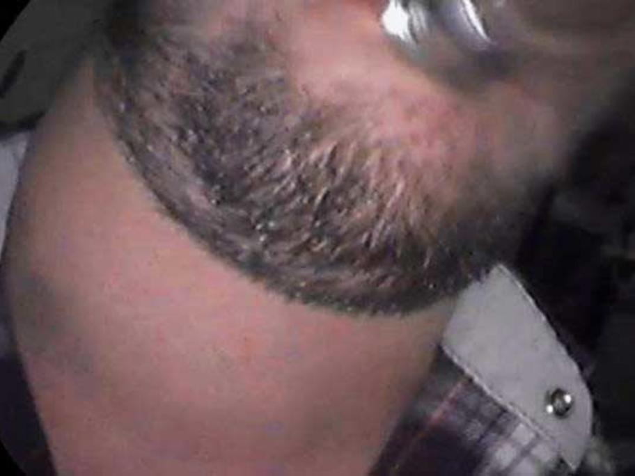 Neck swelling