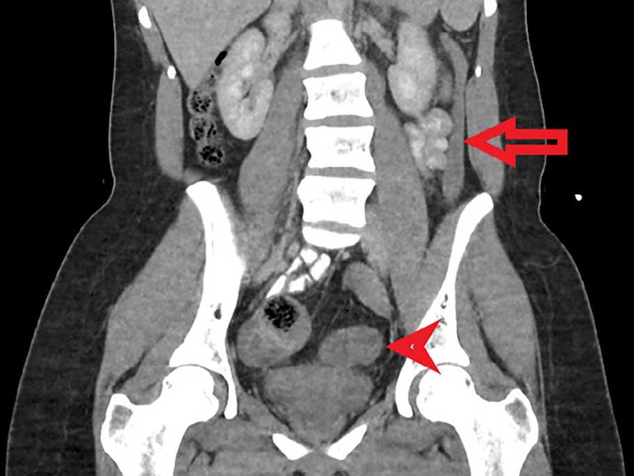 CT scan