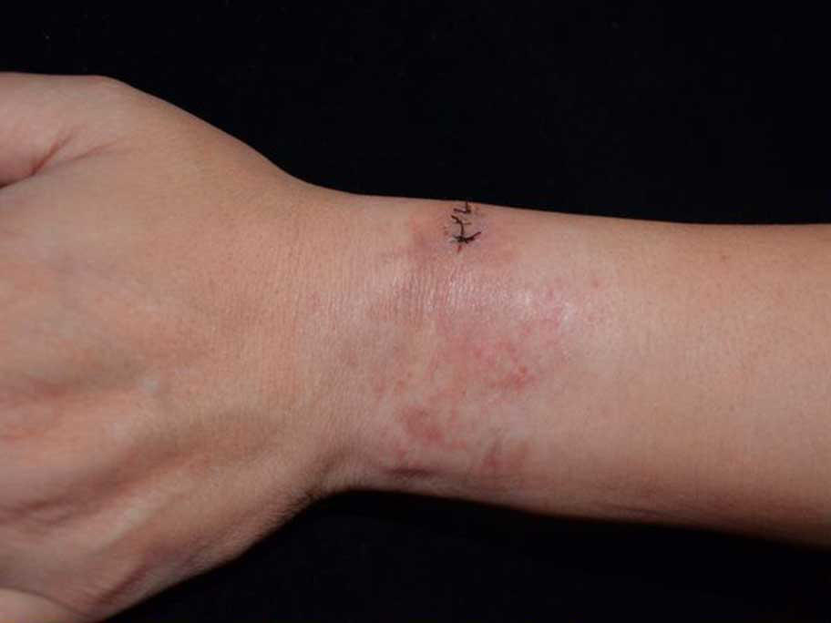 Affected area on patient's wrist