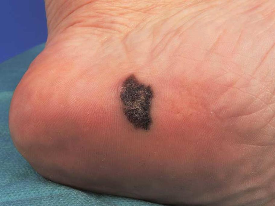 acral melanoma on heel