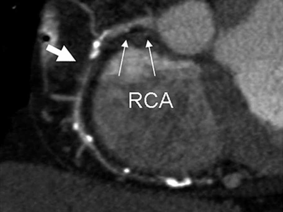 CCTA image of coronary artery with total occlusion
