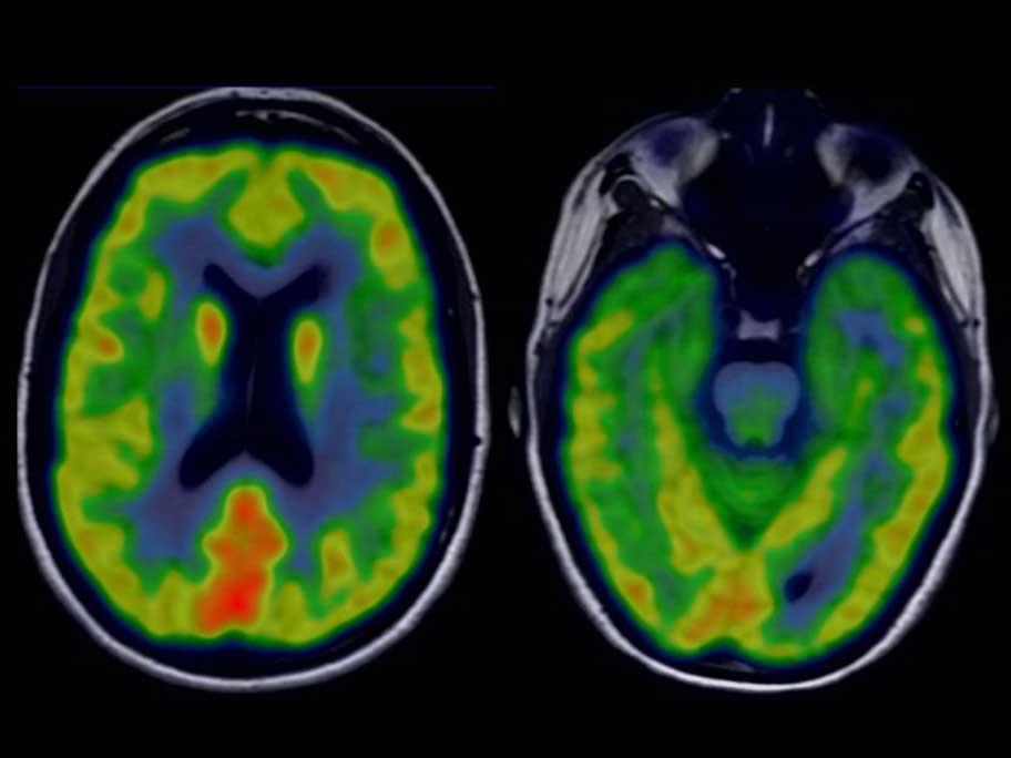 Transverse view of PET. Non-specific scattered areas of low-level hypometabolism are present at the bilateral frontal, left precuneus, occipital and parietal regions. Notably, the gyrus rectus is spared. Source: BMJ Case Reports.