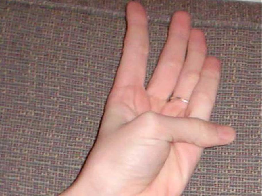 Thumb–palm test
