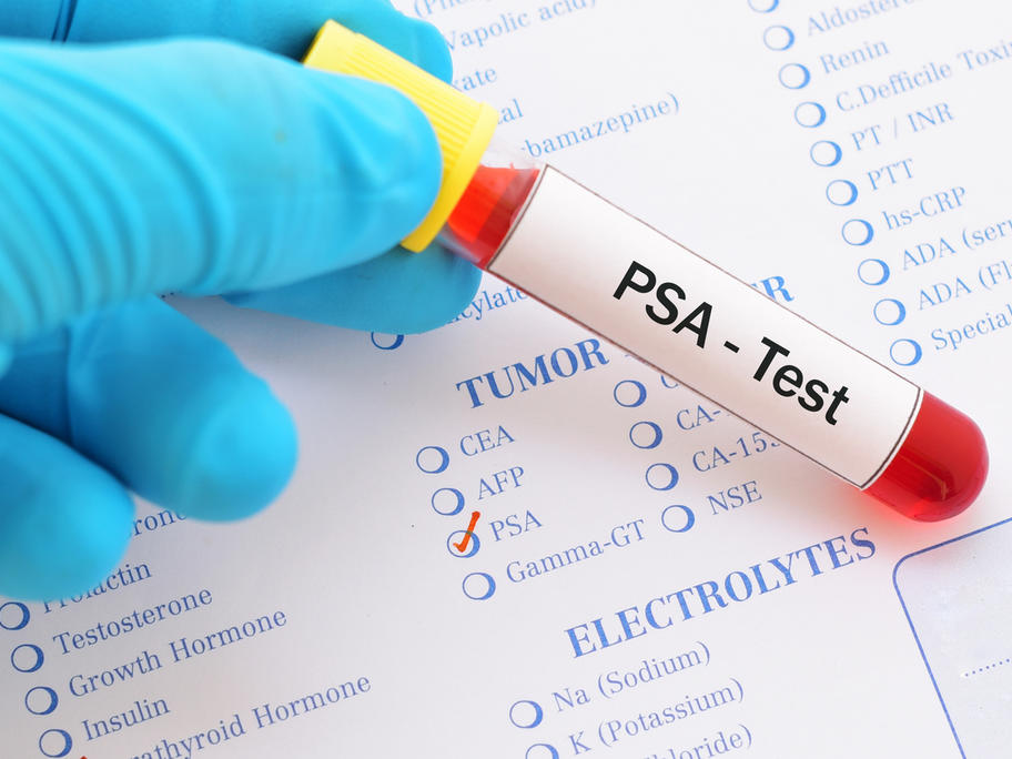 PSA test vial