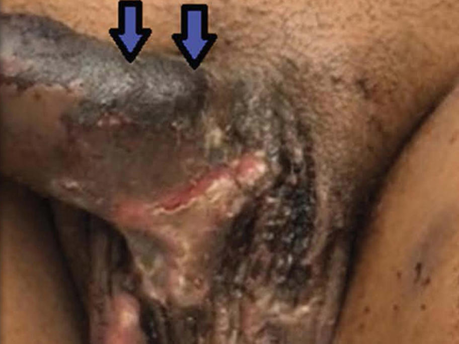 Penile necrosis