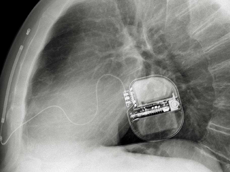 Subcutaneous ICD