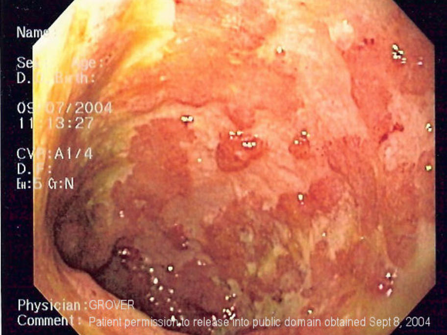 Ulcerative colitis seen on endoscopy