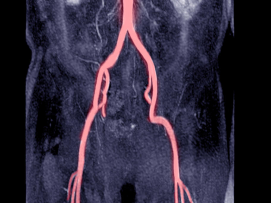 Abdominal Aortic Calcification Predicts Cv Risk Australian Doctor Group