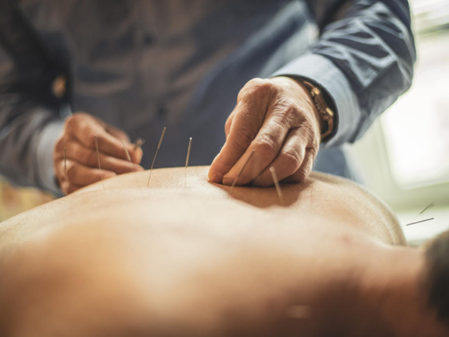 Acupuncture