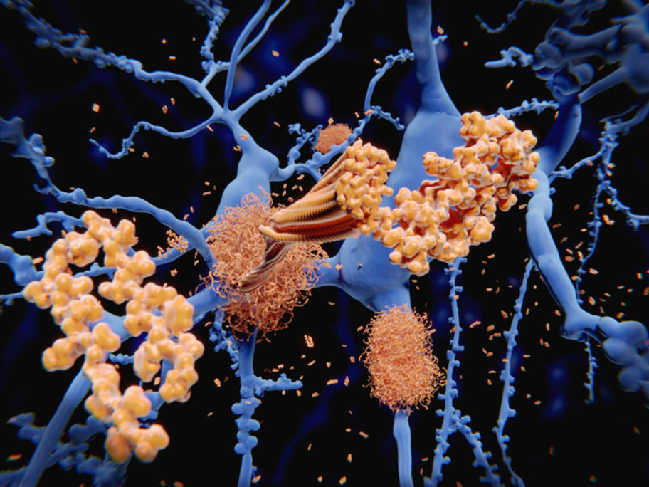 amyloid plaque illustration