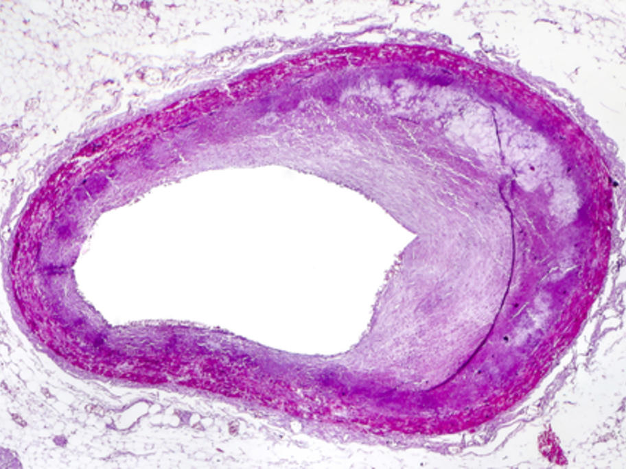 atheroscelrotic aretery under the microscope