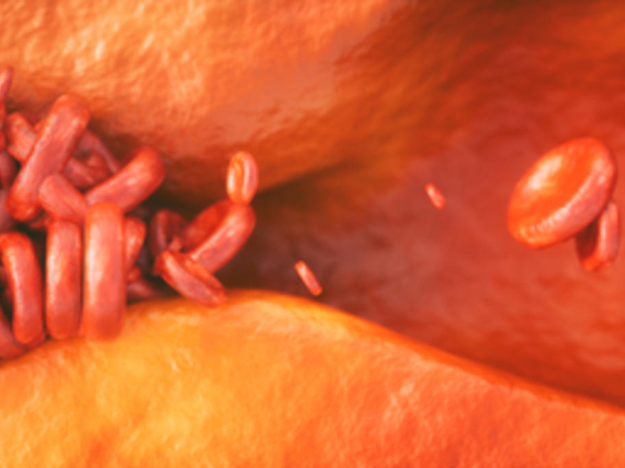 blood cells passing thrpough artery with plaque