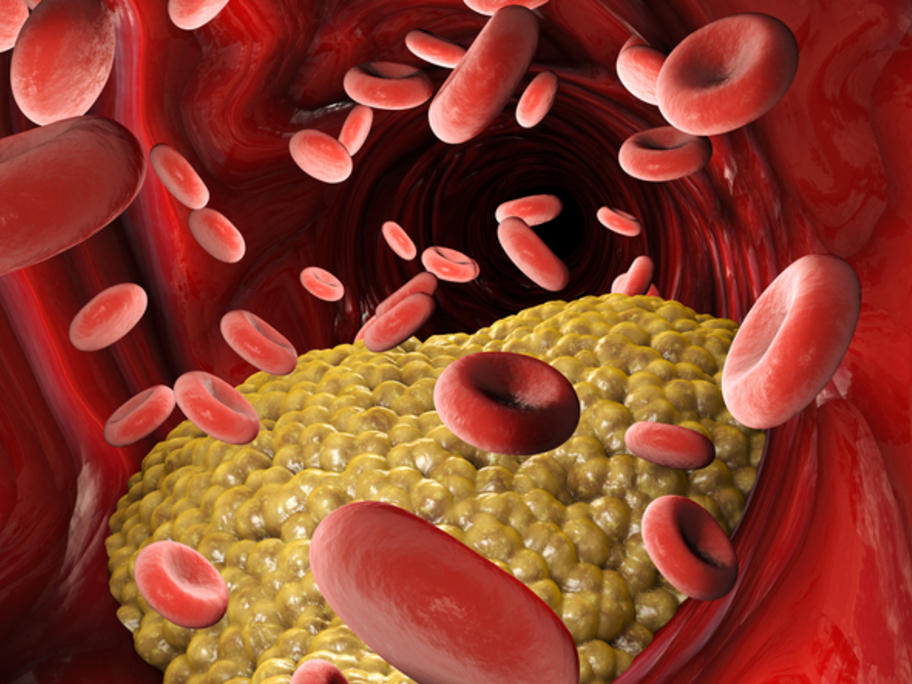 atherosclerosis in an artery
