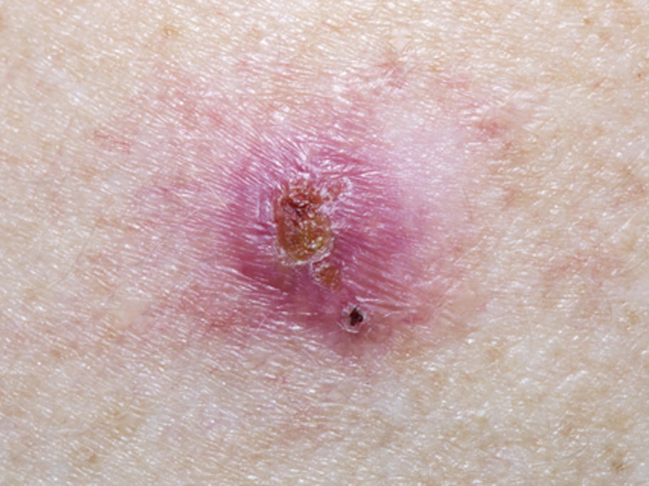 basal cell carcinoma