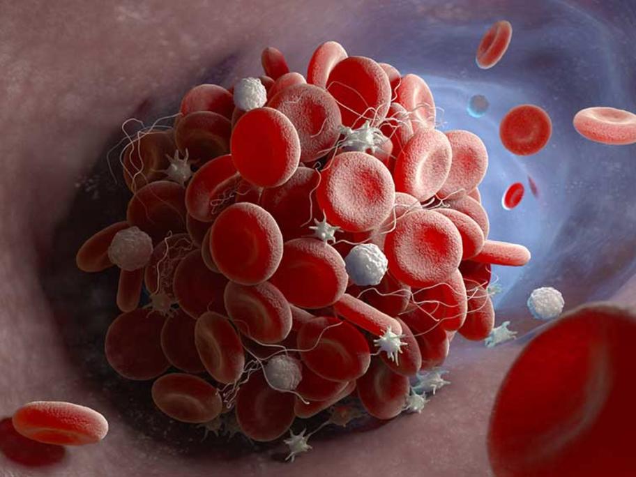 blood clot