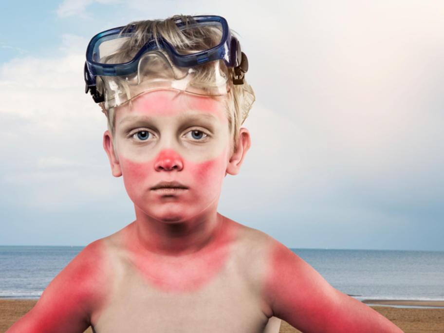 Sunburn
