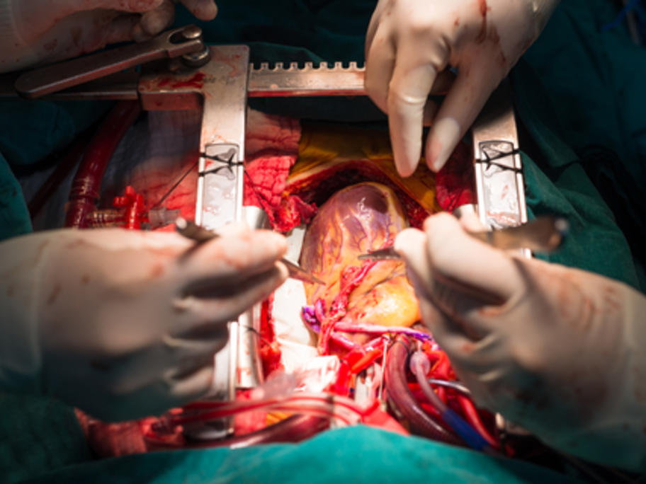 CABG using internal mammary artery graft