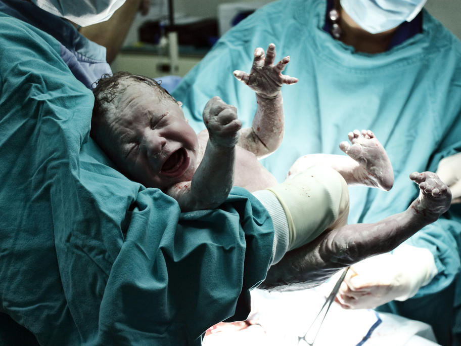 Doctors delivering a baby by caesarian