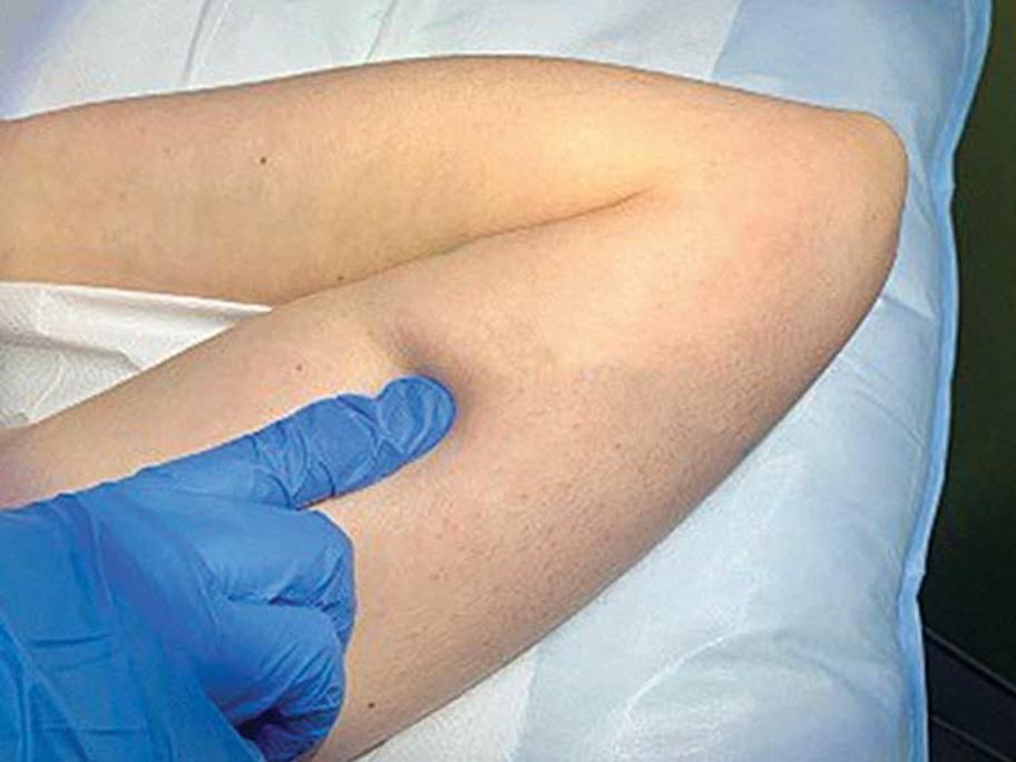 Figure 1. Sacha’s current implant site.