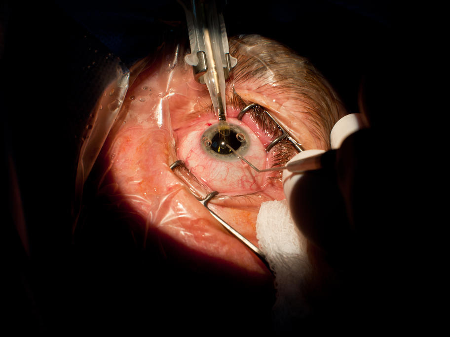 Cataract surgery