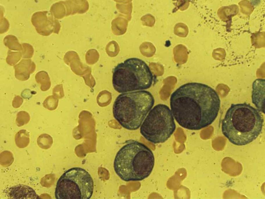 Plasma cells in a marrow film on a myeloma patient.