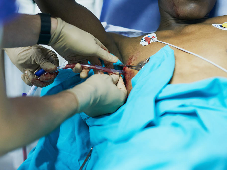 chest drain