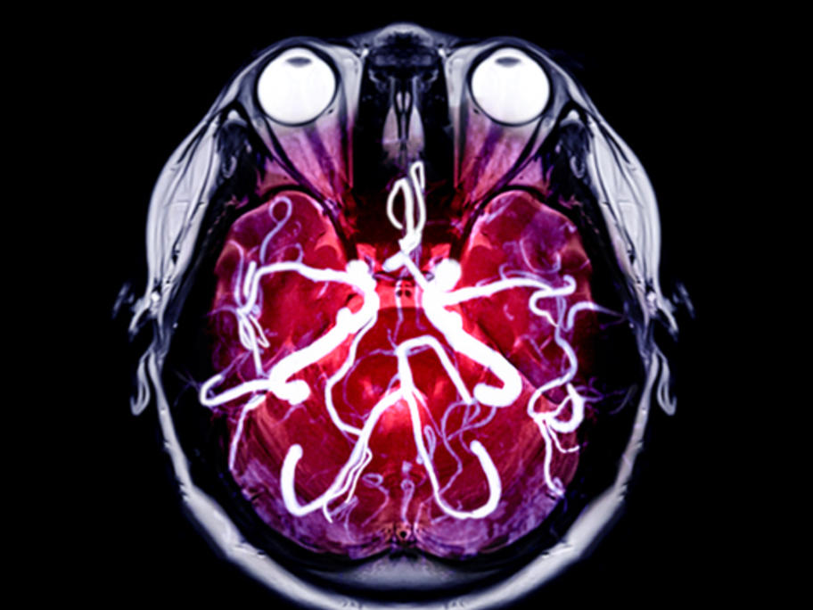 Scan highlighting the Circle of Willis