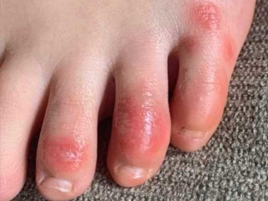 covid toes