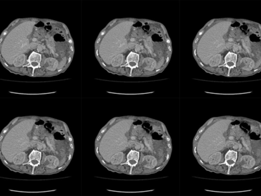 CT scan abdomen