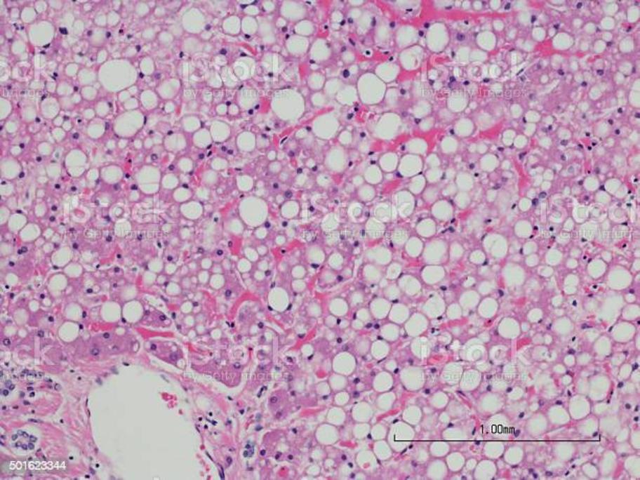 histology - fatty liver diseasse