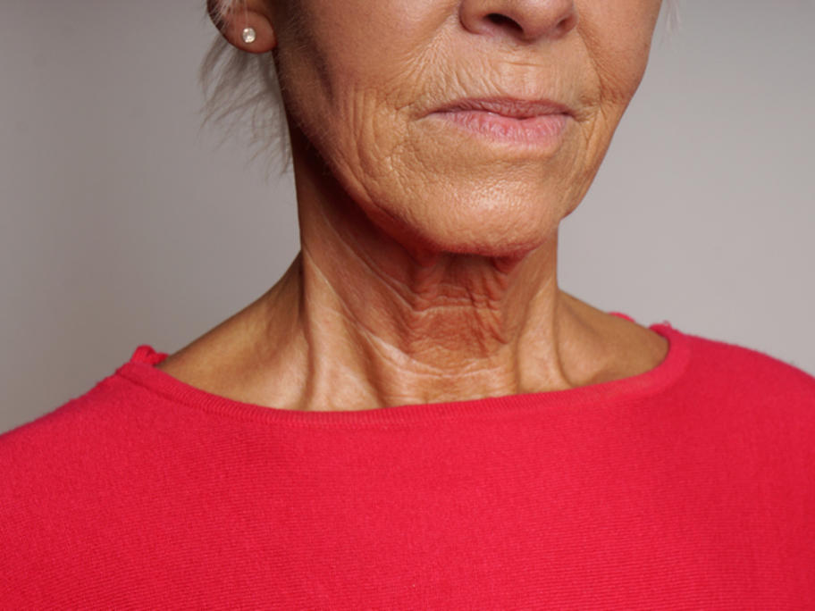 Senior woman's neck to ilustrate jugualr venous pressure