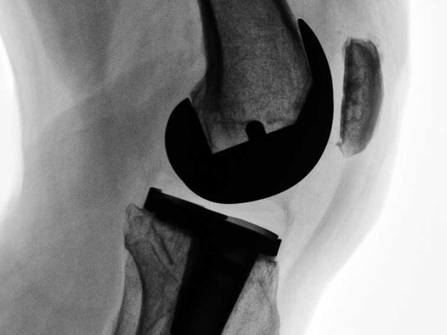 knee replacement