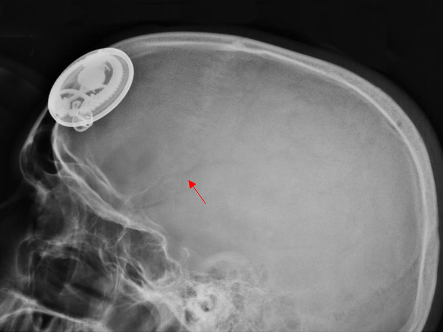 X-ray