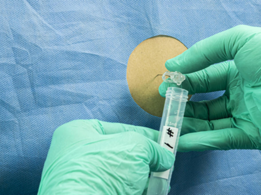 lumbar puncture - CSF being collected