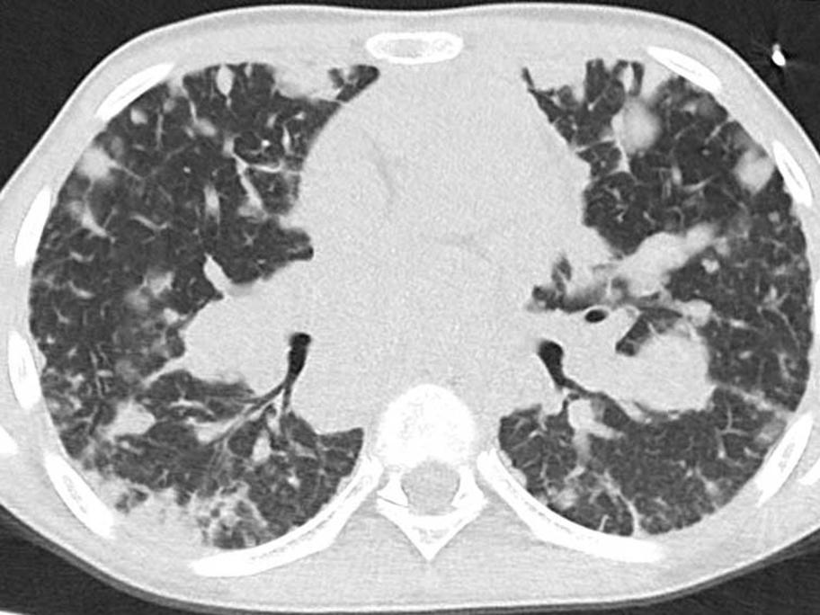 Lung CT