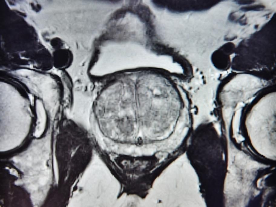 MRI of prostate
