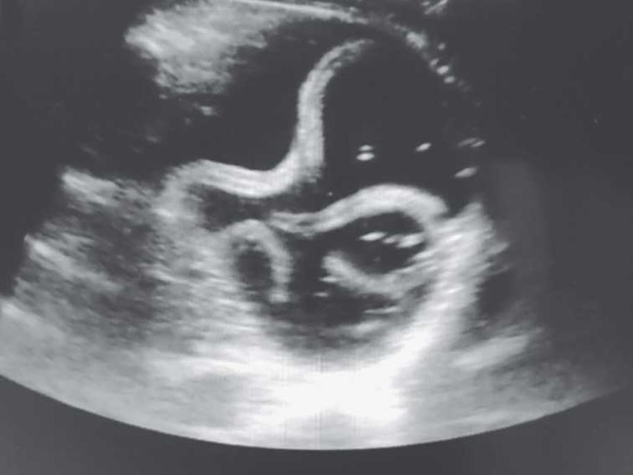 Ultrasound