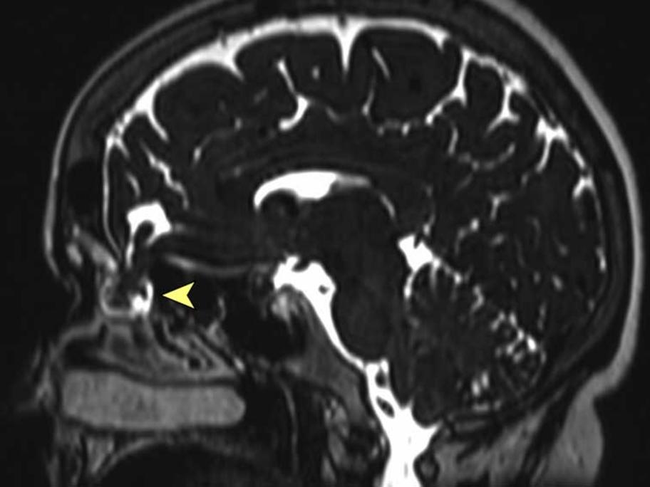 MRI
