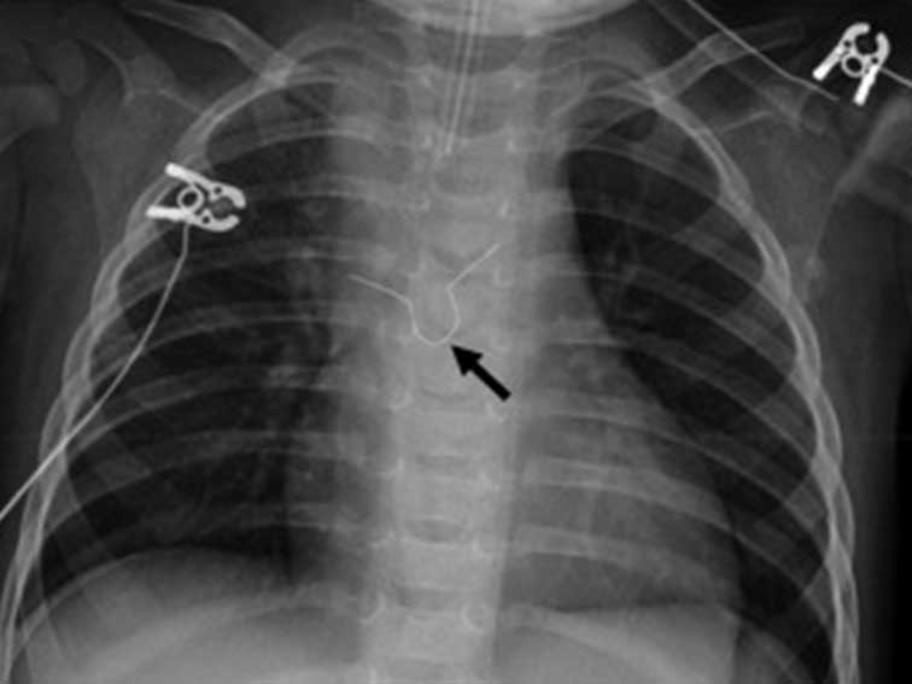 Hook on chest X-ray