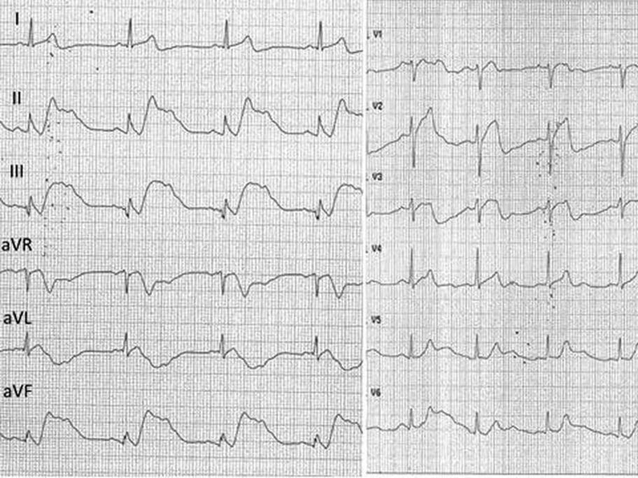 ECG