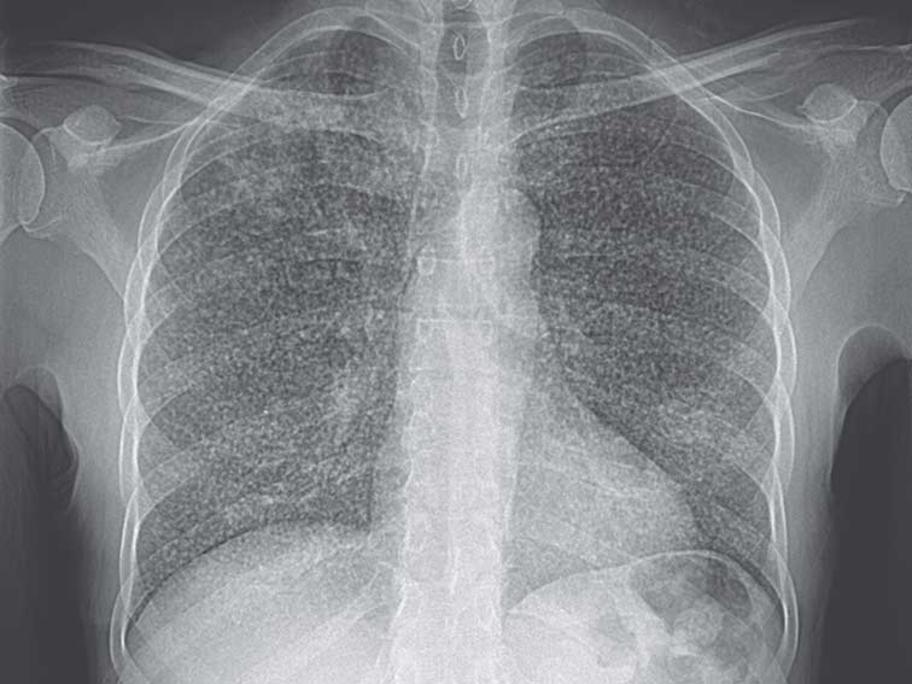 Chest X-ray