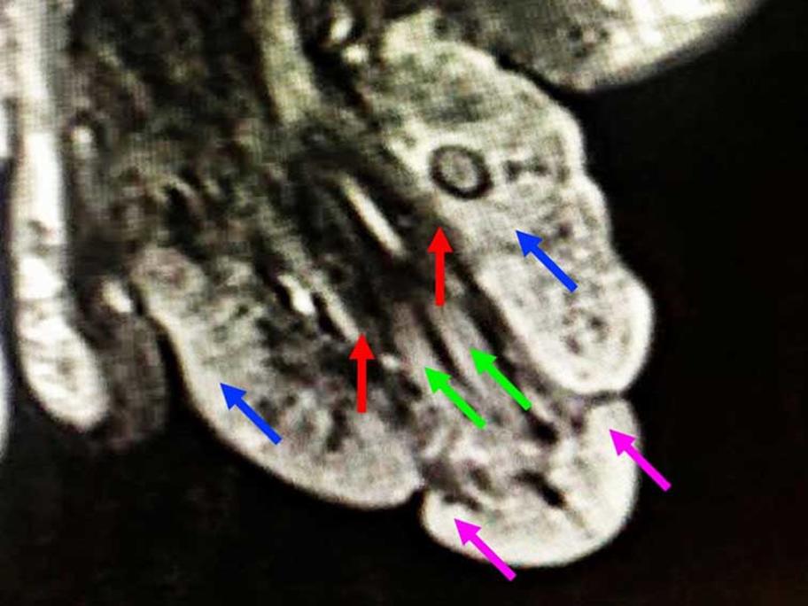 MRI