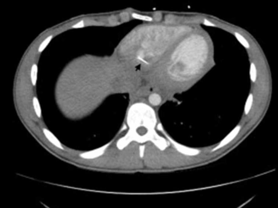 Chest CT
